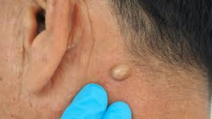 Macam-macam benjolan di tubuh terdiri dari lipoma, kista, bisul, pembesaran kelenjar, benjolan di payudara dan lainnya. Yuk, cek masing-masing pembahasannya!